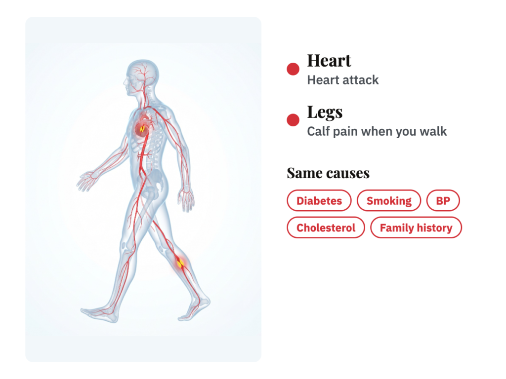 A see-through walking body with red arteries, a block glowing in the heart and another in the calf, beside the five shared causes: diabetes, smoking, BP, cholesterol and family history.